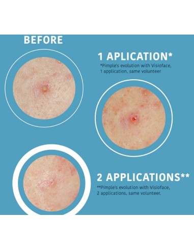 Iroha Nature Cerotti SOS Per Brufoli Con Acido...