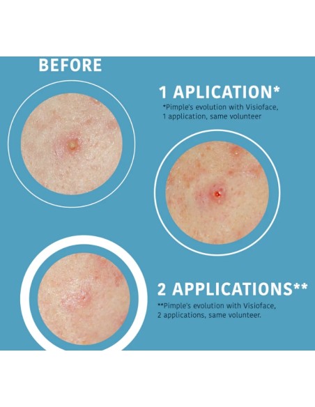 Iroha Nature Cerotti SOS Per Brufoli Con Acido Salicilico 18 patch