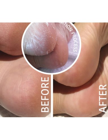 Iroha Nature Maschera Piedi Peeling ed...