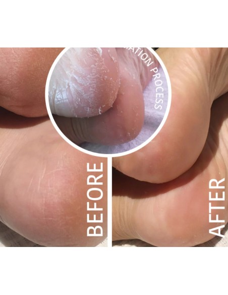 Iroha Nature Maschera Piedi Peeling ed Esfoliante all'Acido Glicolico